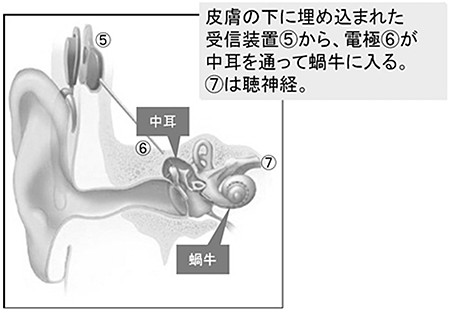 人工内耳のしくみ